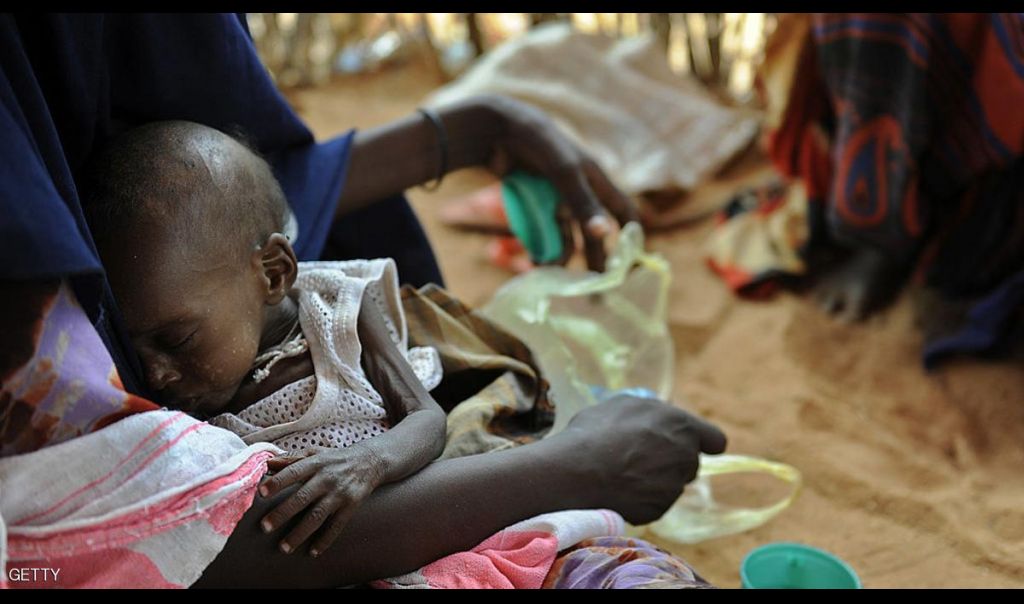 سوء التغذية بالصومال يصل 